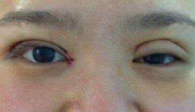 杭州修复双眼皮失败的医疗美容机构有哪些？2023年杭州修复双眼皮失败排名前十的整形医院评选结果！