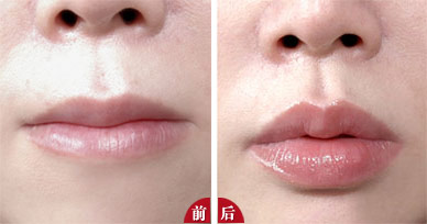 2023年北京透明质酸面部填充医疗美容医院排名揭晓！顾客口碑受欢迎的前十名医院被曝光！