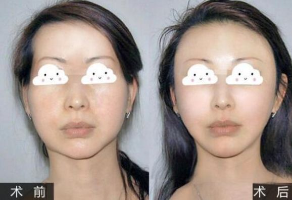 贵州省人民医院双眼皮术：好评如潮的整形医生榜单