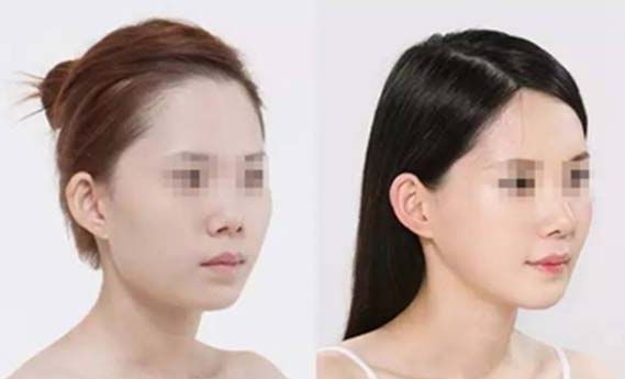 激光美容项目大揭秘：祛斑、抗衰、脱毛全方位解析！