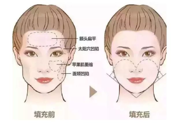 深圳大学第一附属医院整形美容科综合评价及下颌角整形案例分享