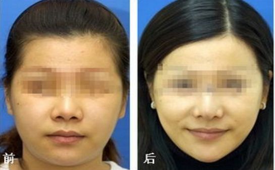 2024韩国隆鼻医院人气排行榜：让你拥有完美鼻型