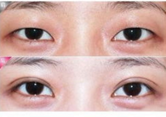 泰州痕焊接双眼皮价目表放出(2023泰州痕焊接双眼皮参考价为：6575元)