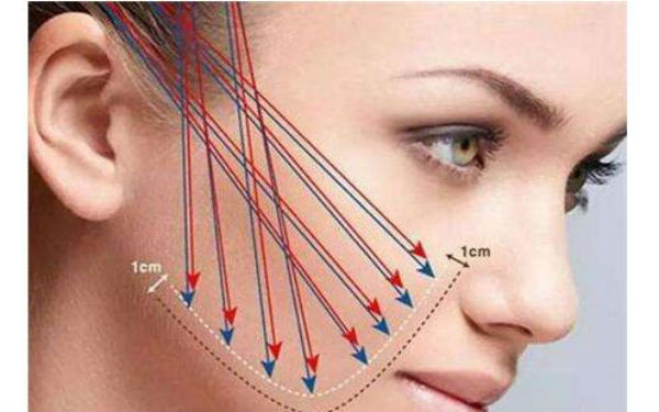 新疆光电改善脸部下垂手术价位表剖析(2023新疆光电改善脸部下垂参考价为：6884元)