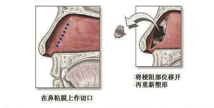 上海知名整形医生李昕的隆鼻手术经验揭秘