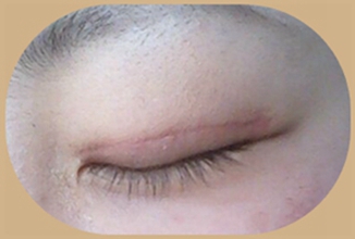 上海柴云做双眼皮修复后的恢复情况如何？亲身见证：3个月的修复案例详解！